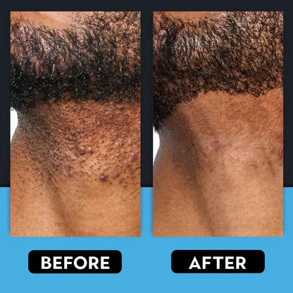 🎁Last day 70% OFF🎁 Ingrown Hair Treatment ：Soothe, Prevent & Smooth for Bump-Free Skin